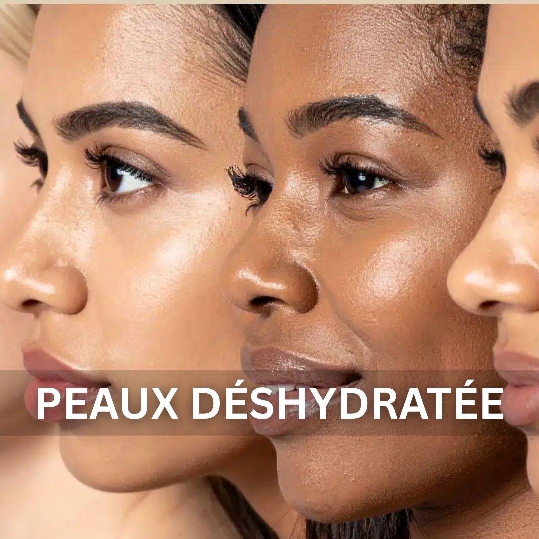 Peaux Déshydratée